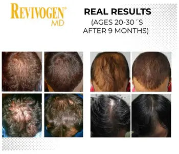 Real results of Revivogen MD after 9 months for ages 20-30, showcasing effective hair regrowth.